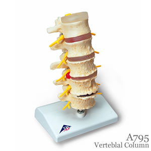 椎間板ヘルニアと変形性脊椎症模型