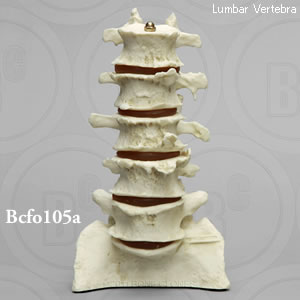 高齢者の骨関節炎腰椎模型 BCFO105A  Bone Clones ボーンクローン
