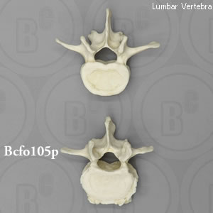 正常腰椎（L3）と関節炎腰椎（L3）の比較模型　2個セット BCFO105P  Bone Clones ボーンクローン