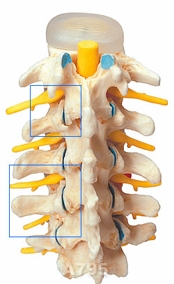 椎間板ヘルニアと変形性脊椎症模型拡大部