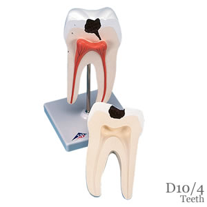 下顎大臼歯（2根）模型