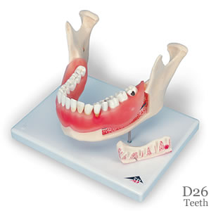 歯と歯茎の疾患模型D26