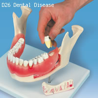 歯と歯茎の疾患　歯の模型　歯の取り外し