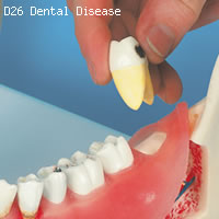 歯と歯茎の疾患　歯の模型　歯の取り外し