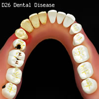 歯と歯茎の疾患　歯の模型　16本の歯