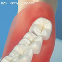 歯と歯茎の疾患　歯の模型　歯の様子