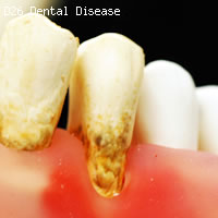 歯と歯茎の疾患　歯の模型　疾患の様子