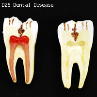 歯と歯茎の疾患　歯の模型　歯の分解