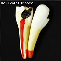 歯と歯茎の疾患　歯の模型　歯の分解