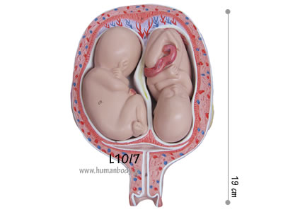 妊娠5ヶ月双生児の子宮と胎児