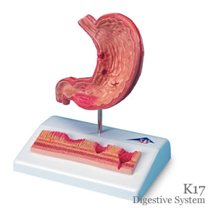 胃潰瘍模型