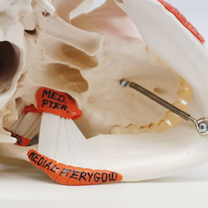 頭蓋骨模型A24の内側翼突筋と外側翼突筋の様子