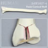 骨折性橈骨（左・大）