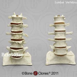 正常腰椎と関節炎腰椎の比較模型 BCFO105AY  Bone Clones ボーンクローン