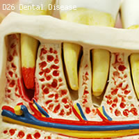 歯と歯茎の疾患　歯の模型　下顎骨開放