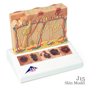 皮膚癌の模型