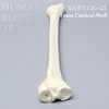 骨折性脛骨（左・大）