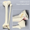 骨折性脛骨と腓骨（左・大）