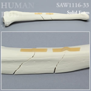 骨折性脛骨（左・中） SAW1116-33 ソーボーン模擬骨