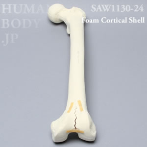 骨折性大腿骨（左・大） SAW1130-24 ソーボーン模擬骨