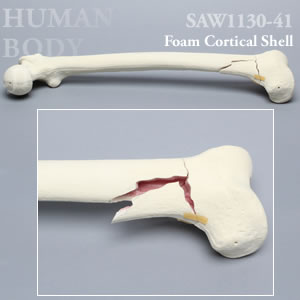 骨折性大腿骨（左・大） SAW1130-41 ソーボーン模擬骨