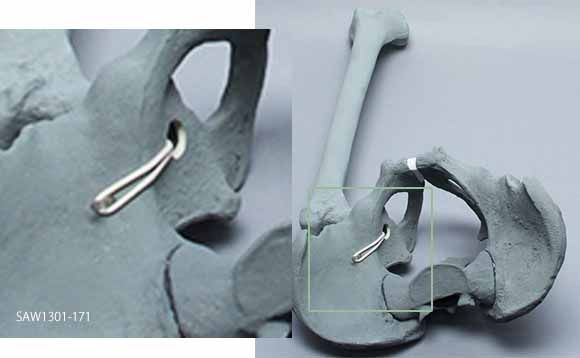 X線ファントム骨盤（大腿骨左付）SAW1301-171の骨盤と大腿骨の連結部拡大。